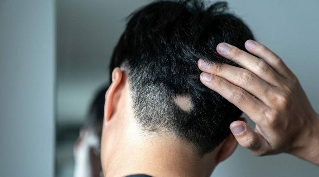 milicia Acurrucarse fama Qué es la alopecia areata, causas y tratamientos