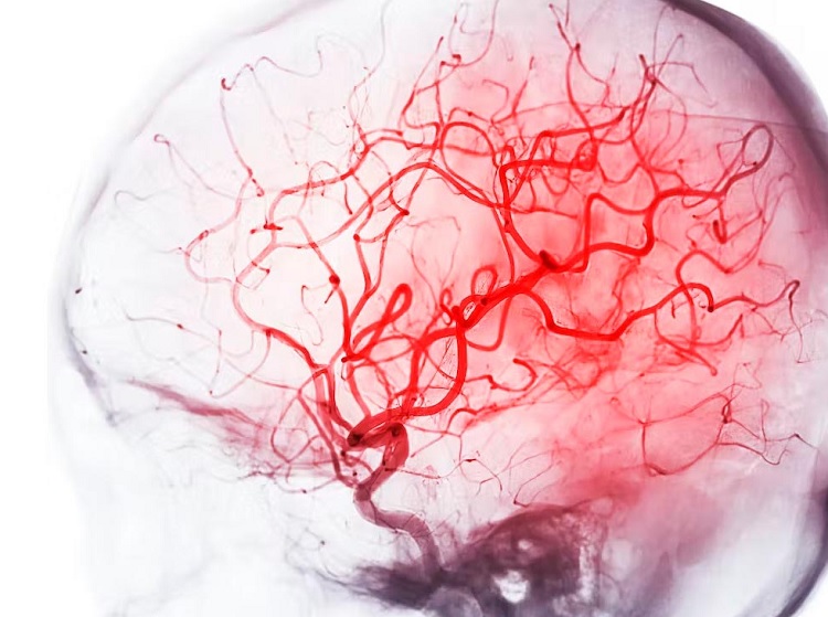 Angiografía cerebral cómo se realiza y cuáles son sus riesgos